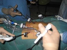 Лапароскопическая операция при ожирении Лечение ожирения в Израиле Хирургия снижения веса