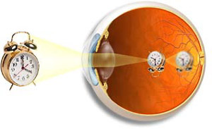 http://www.rusmedserv.com/files/ophthalmolog/miop_p2.jpg