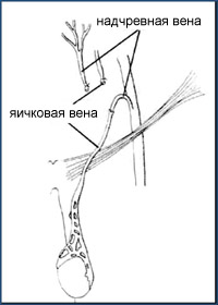 ЛЕЧЕНИЕ ВАРИКОЦЕЛЕ - Микрохирургическая реваскуляризация яичка