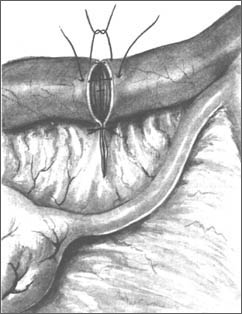 тубо-тубарный анастомоз (реконструкция маточной трубы в области истмического отдела)