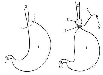 бандажирование желудка