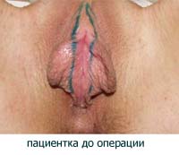 Пластика малых половых губ - вид после операции