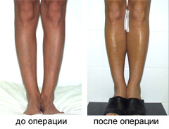 Коррекция формы ног при их искривлении