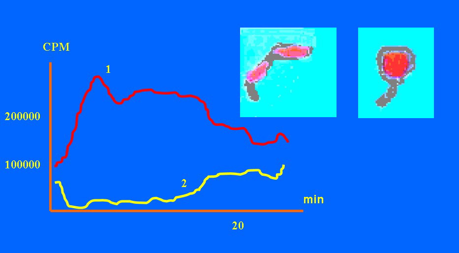 Рис 3 – Субкомпенсированный пилородуоденальный стеноз. Моторно-эвакуаторная функция желудка (1), двенадцатиперстной (2) кишки.