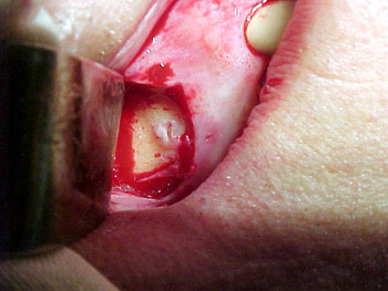 http://www.rusmedserv.com/jawsurg/periodon/Image5.jpg