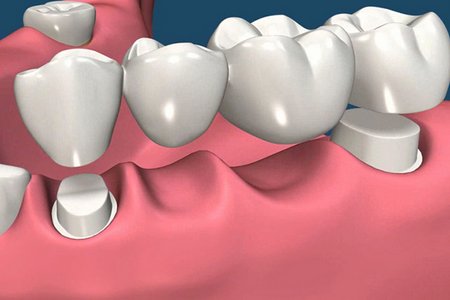 Мостовидный протез с опорой на естественные зубы