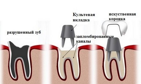 Культевые коронки