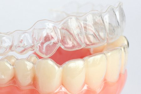 Каппы Invisalign