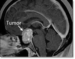 Опухоль гипофиза