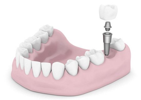 Протезирование зубов после имплантации
