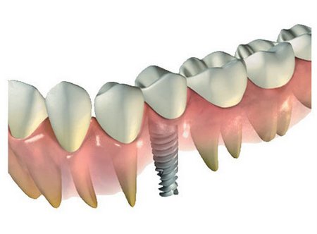 Противопоказания для имплантации зубов