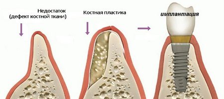 Восстановление костной ткани (трансплантация) в имплантологии