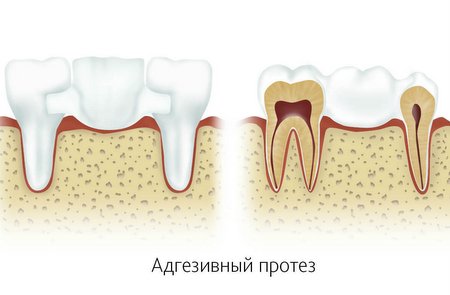 Адгезивно - мостовидные протезы