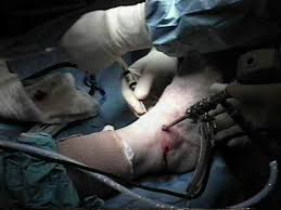 Артроскопия голеностопного сустава