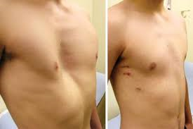 Врожденная деформация грудной клетки - до и после операции