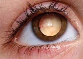 рак глаза