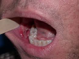 Рак слизистой полости рта