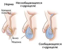 Гидроцеле - операции в Москве