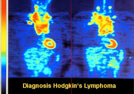 Диагностика лимфомы Ходжкина