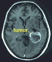 Опухоль головного мозга