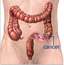 Рак кишечника