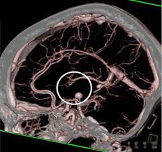 Аневризма сосудов головного мозга