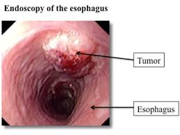 Рак пищевода