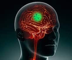 Лучевая терапия метастазов в головном мозге