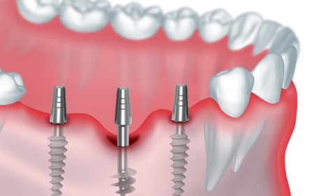 Этапы имплантации зубов