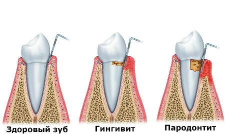 Пародонтит 