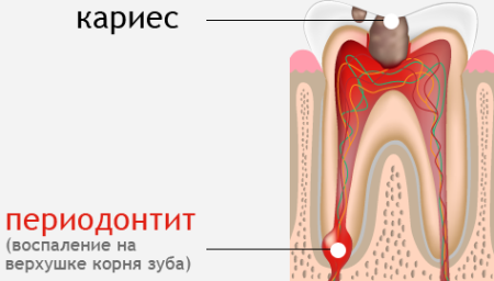 Периодонтит - симптомы и лечение