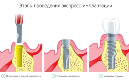 Безоперационная имплантация зубов