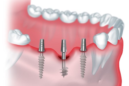 Виды зубных имплантатов
