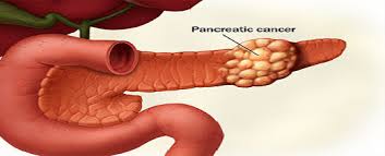 Рак поджелудочной железы