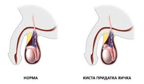 Киста придатка яичка