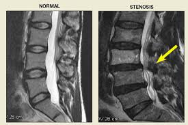 Спинальный стеноз