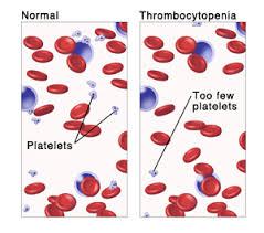 Тромбоцитопения