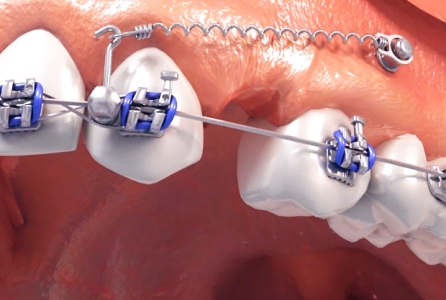 Ортодонтические импланты в Германии
