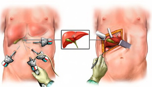 Удаленный Желчный Пузырь Фото