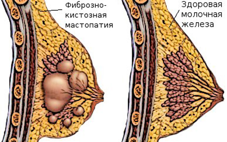 Народные методы, препараты для лечения мастопатии :: Бальзам Сергеев