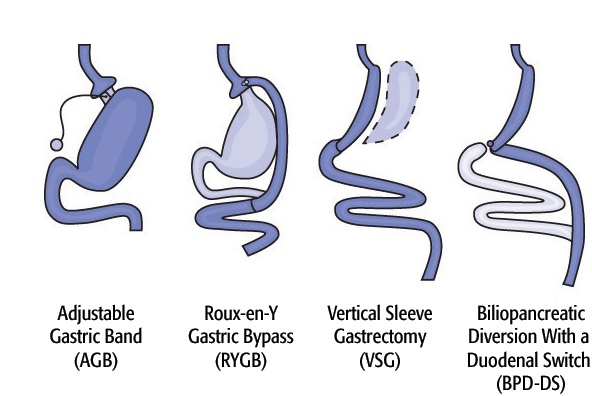 Основные виды бариатрических операций в Израиле Лечение ожирения в ...