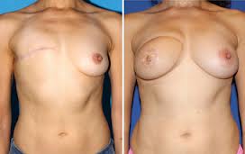 Mastectomy Porn