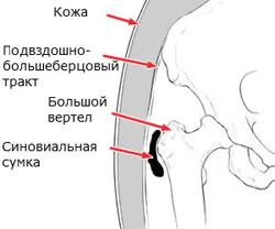 Бурсит тазобедренного сустава. Бурсит тазобедренного сустава: причины, симптомы, лечение Травматичні пошкодження та захворювання кульшового суглоба. Все, що ви. Бурсит тазобедренного сустава – частая причина боли в бедре.