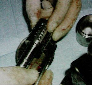 Bone-Mill (Костная мельница) - ASTRA TECH AB - Cпециальный репортаж РМС-Экспо