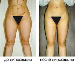 липосакция