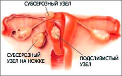 Миома матки