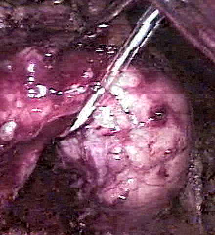 Псевдопапиллярная опухоль поджелудочной железы лечение thumbnail