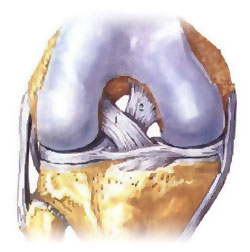 Операция колено пкс. Разрыв ПКС коленного сустава. Разрыв связок коленного сустава ПКС операция. Разрыв крестообразной связки коленного сустава. Разрыв крестообразной связки колена.