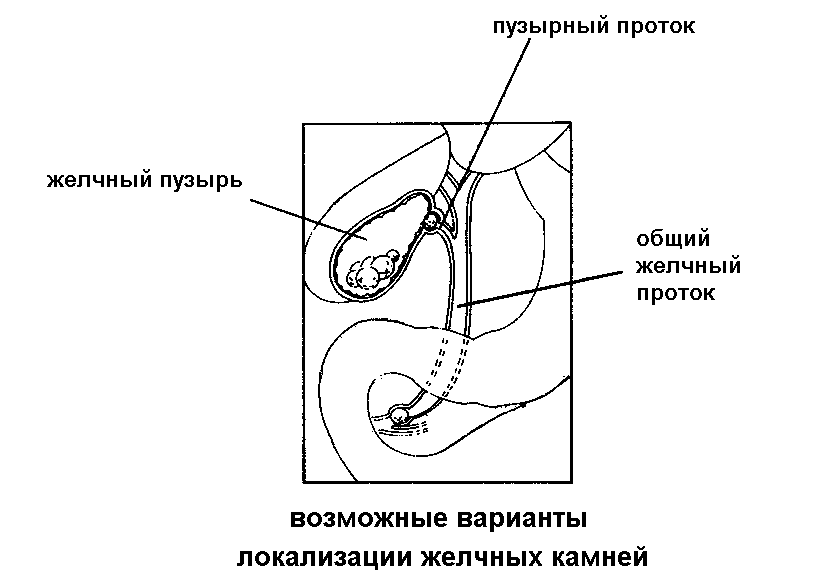 Удаление желчного пузыря отзывы врачей