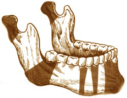 Переломы челюстей этиология классификация